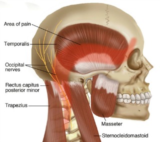 https://www.arvadasportandspine.com/application/files/2915/5718/4245/tension_headache.jpg